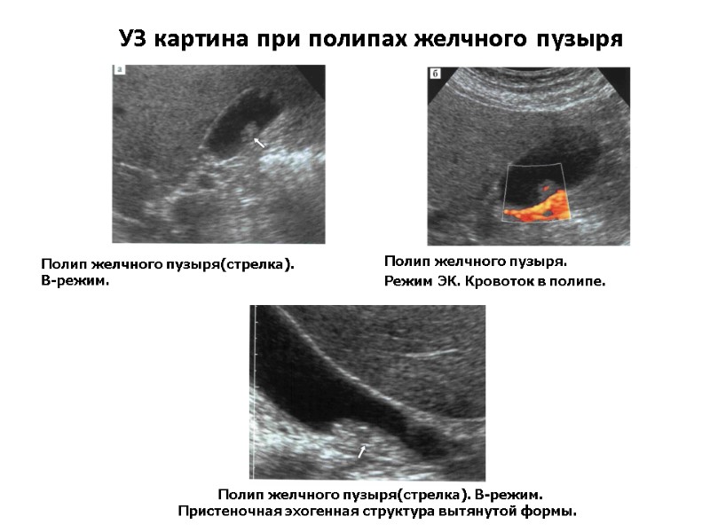 УЗ картина при полипах желчного пузыря Полип желчного пузыря(стрелка).  В-режим.  Полип желчного